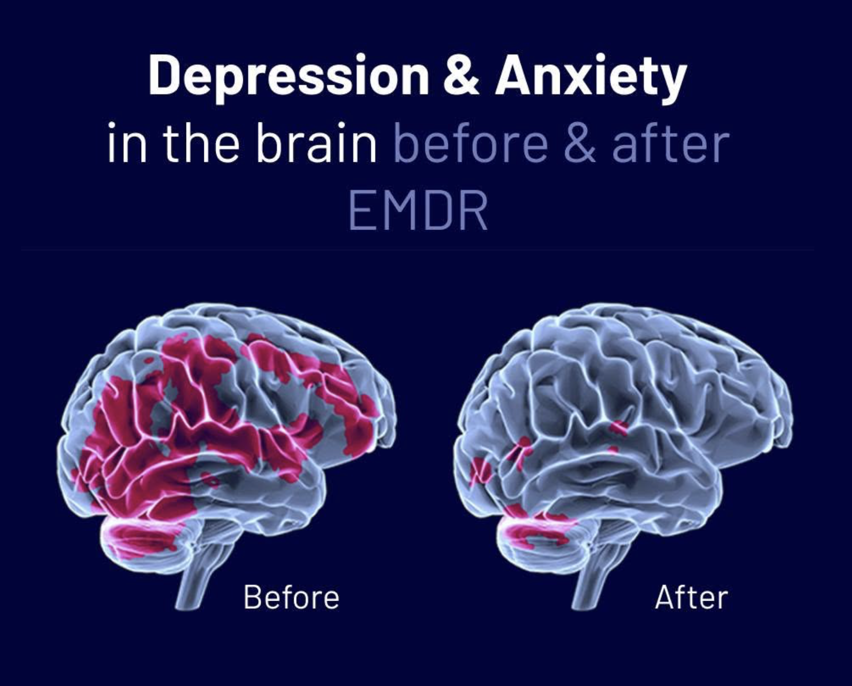 Brain scans showing depression and anxiety activity before and after EMDR therapy